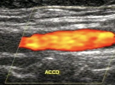 DOPPLER  – O que é e para que serve ?