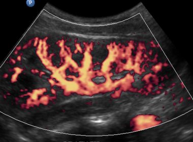 Aula “Doppler no Rim transplantado” na AMBr