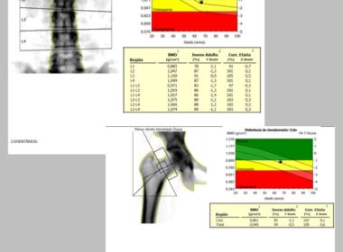 Densitometria Óssea – O que é e para que serve?